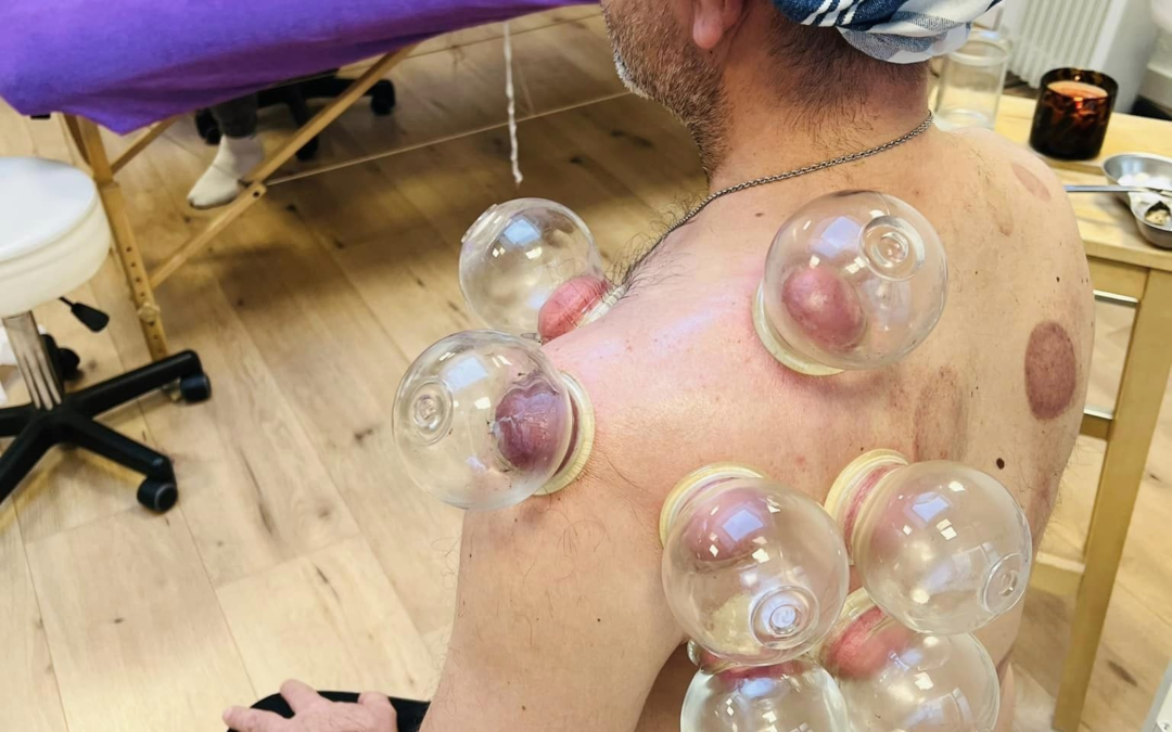 Massage aux ventouses